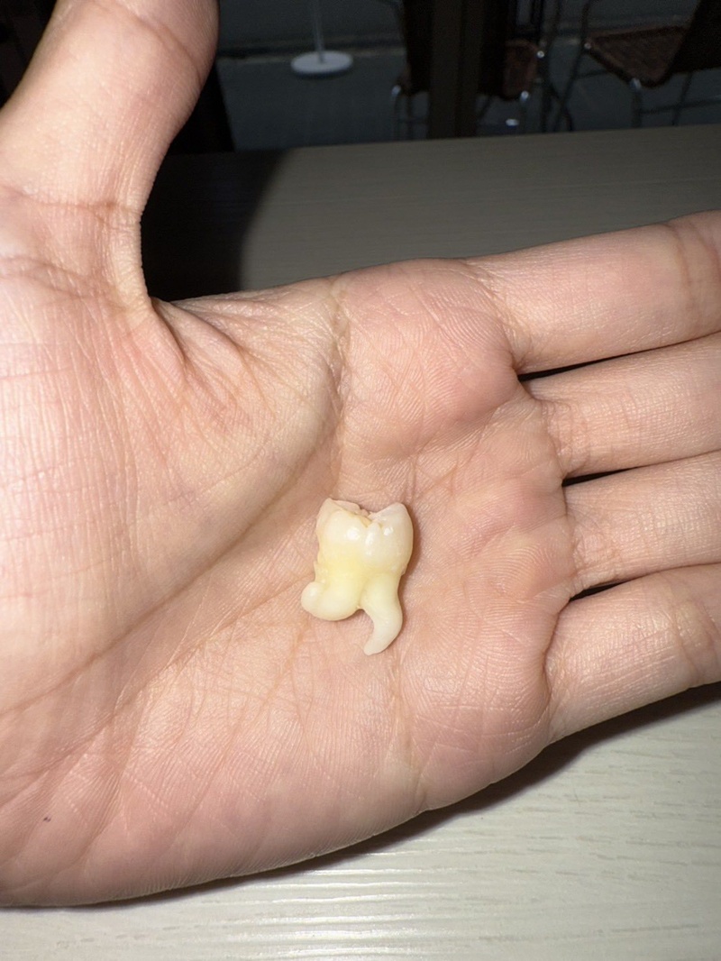 ภาพฟันคุดสาวญี่ปุ่น กลายเป็นไวรัล 17 ล้าน