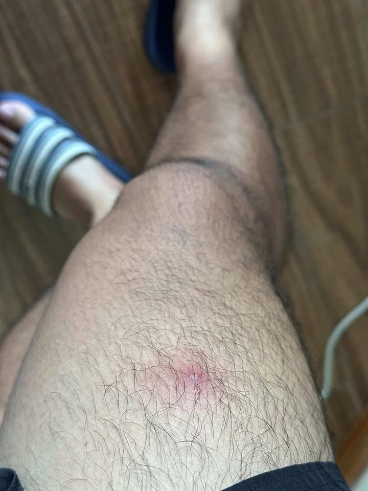 หนุ่มไทยเจอตุ่มปริศนาที่ขา ช็อกว่าเป็นตัวอ่อนแมลงวันไชผิว