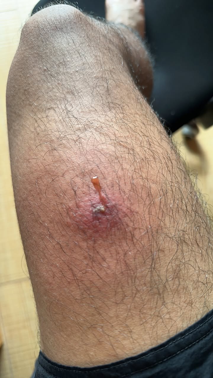 หนุ่มไทยเจอตุ่มปริศนาที่ขา ช็อกว่าเป็นตัวอ่อนแมลงวันไชผิว 