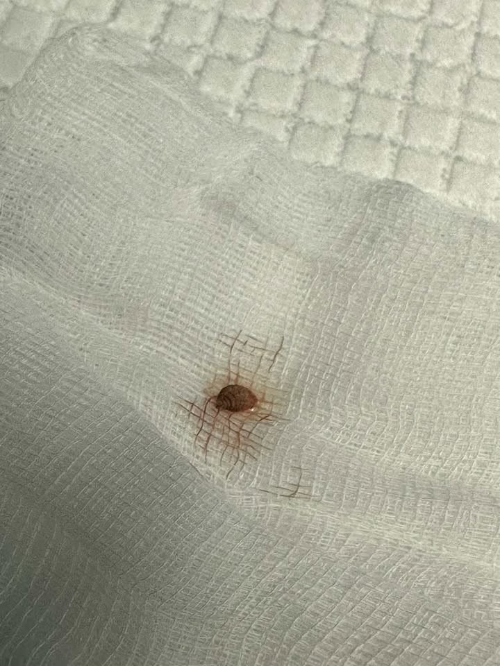 หนุ่มไทยเจอตุ่มปริศนาที่ขา ช็อกว่าเป็นตัวอ่อนแมลงวันไชผิว