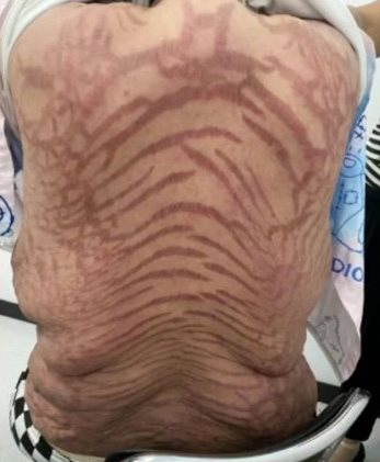 หญิงจีนเผยสภาพหลังลายราวกับหนังงู ต้นเหตุจากใช้ยาแก้คัน หญิงจีนเผยสภาพหลังลายราวกับหนังงู ต้นเหตุจากใช้ยาแก้คัน