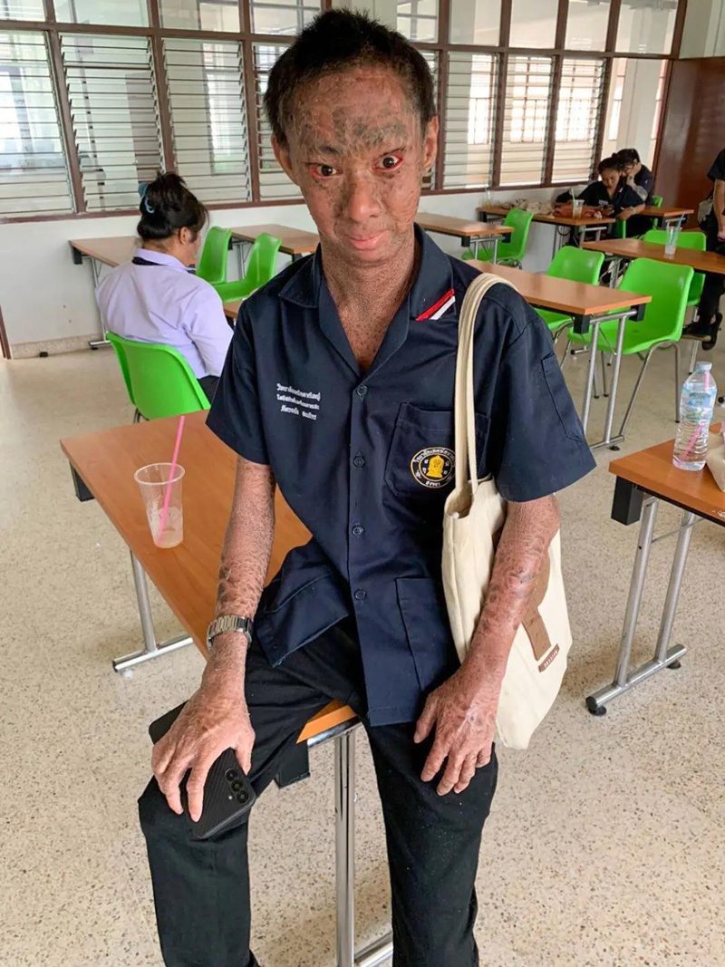 น้องยูฟ่า ป่วยโรคดักแด้ เรียนจบแล้ว