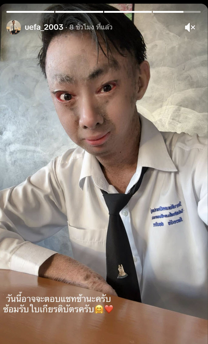 น้องยูฟ่า ป่วยโรคดักแด้ เรียนจบแล้ว 