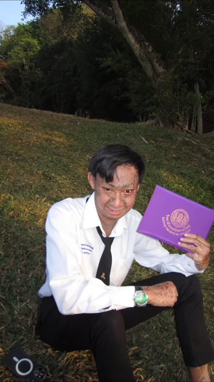 น้องยูฟ่า ป่วยโรคดักแด้ เรียนจบแล้ว 