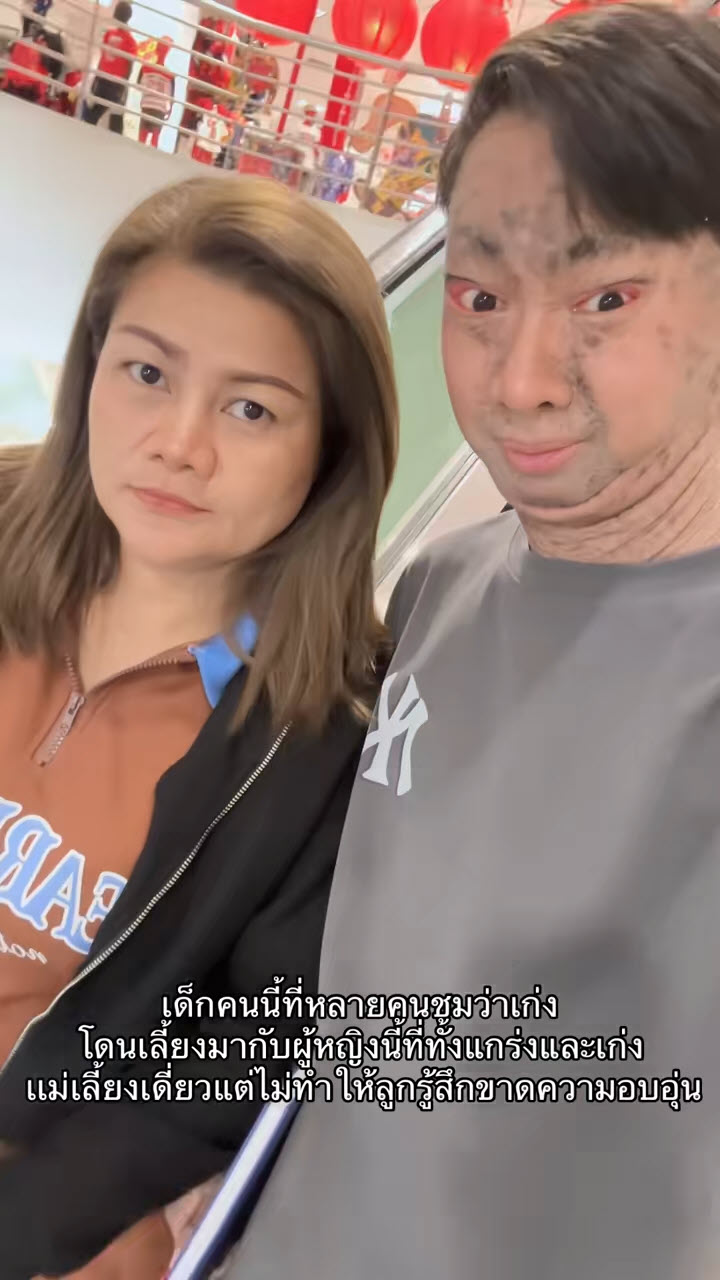 น้องยูฟ่า ป่วยโรคดักแด้ เรียนจบแล้ว