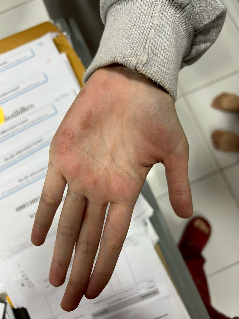 คนวิเคราะห์ ทำไม ซิฟิลิส กับ HIV ระบาดหนักมาก ที่มหาสารคาม คนวิเคราะห์ ทำไม ซิฟิลิส กับ HIV ระบาดหนักมาก ที่มหาสารคาม