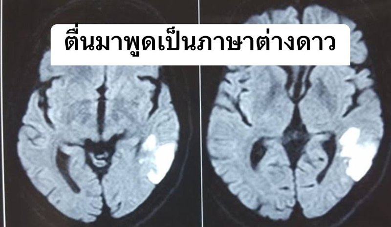 หมอเล่าเคส สามีคนไข้ตื่นมาพูดภาษาต่างดาว ฟังแล้วรู้ โรคอะไร