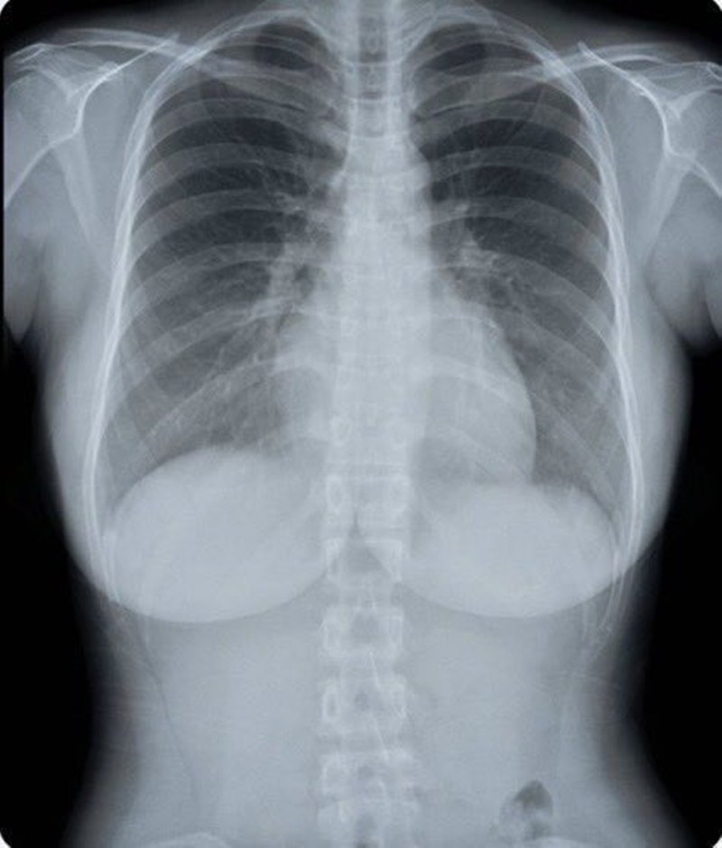 สาวโพสต์ภาพ X-Ray เต้านม ทำคนหลุดโฟกัส กลายเป็นประเด็นร้อน สาวโพสต์ภาพ X-Ray เต้านม ทำคนหลุดโฟกัส กลายเป็นประเด็นร้อน