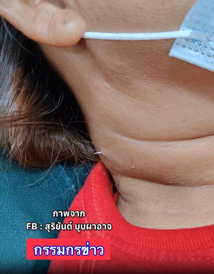 ก้างติดคอ