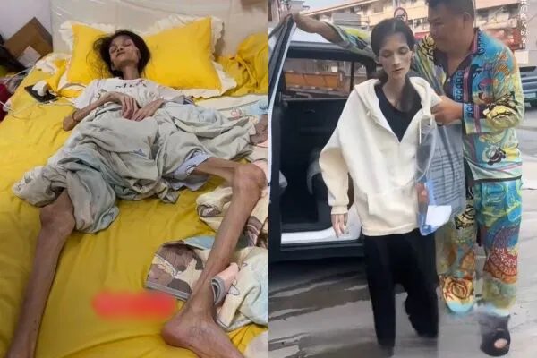 สาวหนักแค่ 17 กก. กระเพาะอาหารฝ่อ 