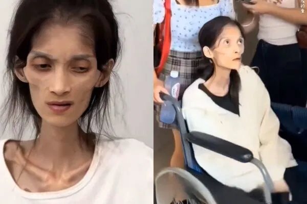 สาวหนักแค่ 17 กก. กระเพาะอาหารฝ่อ 