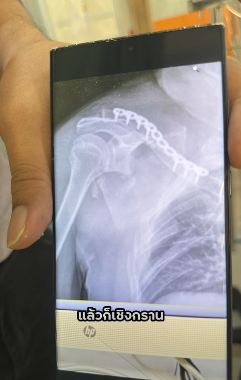 พิมรี่พาย ใจจะขาด พ่อประสบอุบัติเหตุ - บิ๊กไบค์ขาด 2 ท่อน 