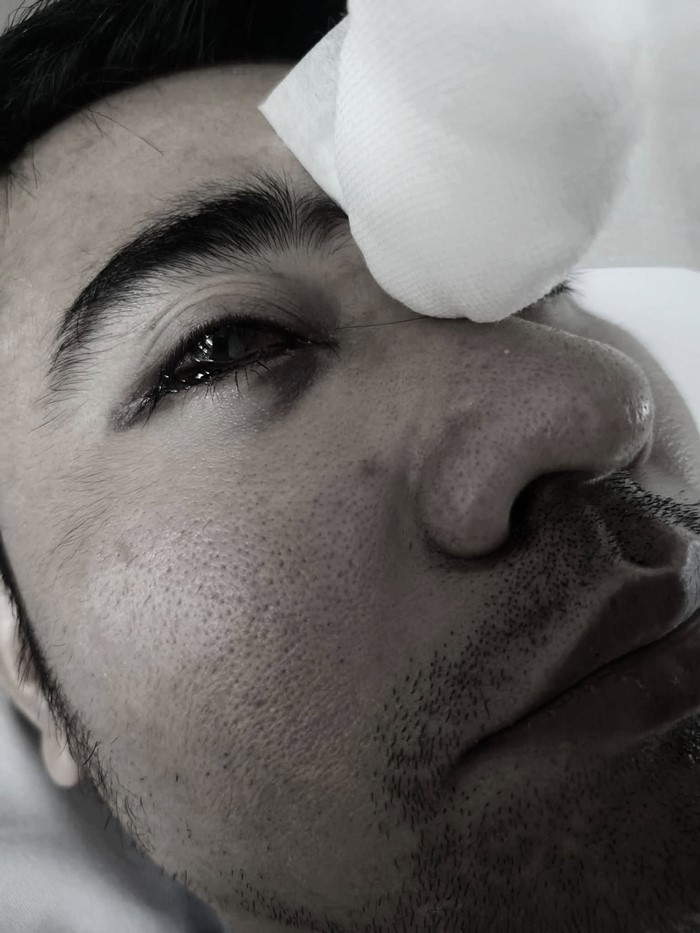 ริดสีดวงจมูก ผ่าตัดรักษา ทำให้ตามองไม่เห็น 