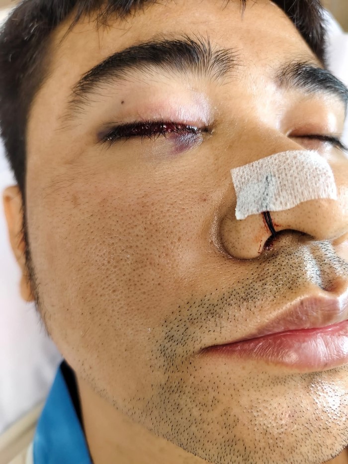 ริดสีดวงจมูก ผ่าตัดรักษา ทำให้ตามองไม่เห็น 