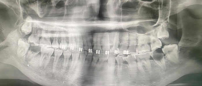 จัดฟันแฟชั่น