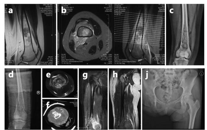 สาวจีนวัย 18 ป่วยมะเร็งถูกตัดขา ซ้ำถูกพ่อแม่ทิ้งเพราะเป็นภาระ สาวจีนวัย 18 ป่วยมะเร็งถูกตัดขา ซ้ำถูกพ่อแม่ทิ้งเพราะเป็นภาระ