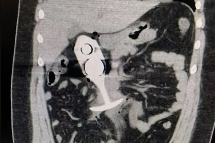 อุทาหรณ์ช็อก สาวตรวจ MRI แอบมีของเล่นผู้ใหญ่อยู่ในท่อนล่าง