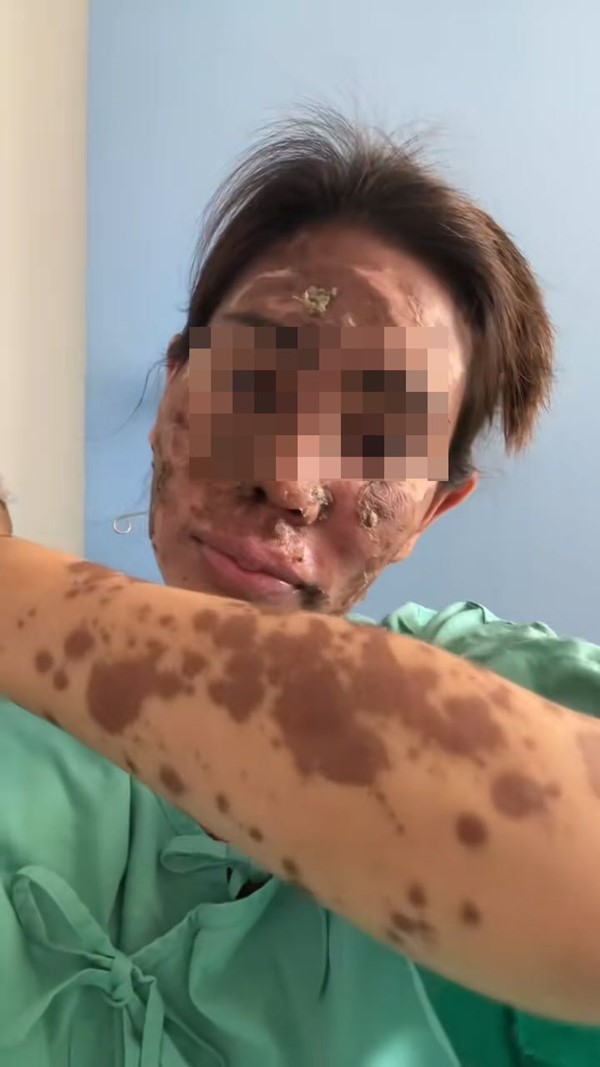  ผื่นขึ้น อย่ามองข้าม 