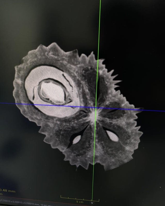 CT Scan น้องทุเรียน