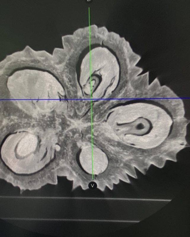CT Scan น้องทุเรียน