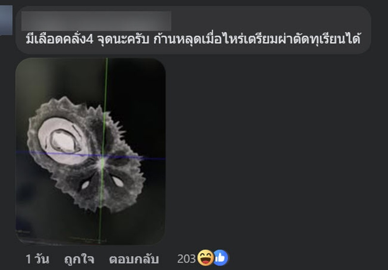 CT Scan น้องทุเรียน