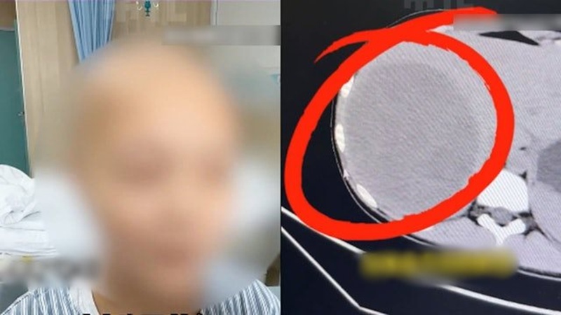 เด็กหญิงวัย 15 เป็นมะเร็งตับระยะสุดท้าย