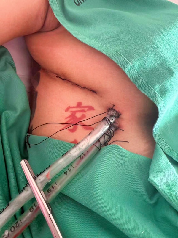 ดูดพอตทางจมูก 2 ปี เปลี่ยนชีวิต