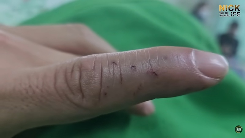 นิค Wildlife ผู้เชี่ยวชาญด้านงูถูกจงอางฉก นิค Wildlife ผู้เชี่ยวชาญด้านงูถูกจงอางฉก