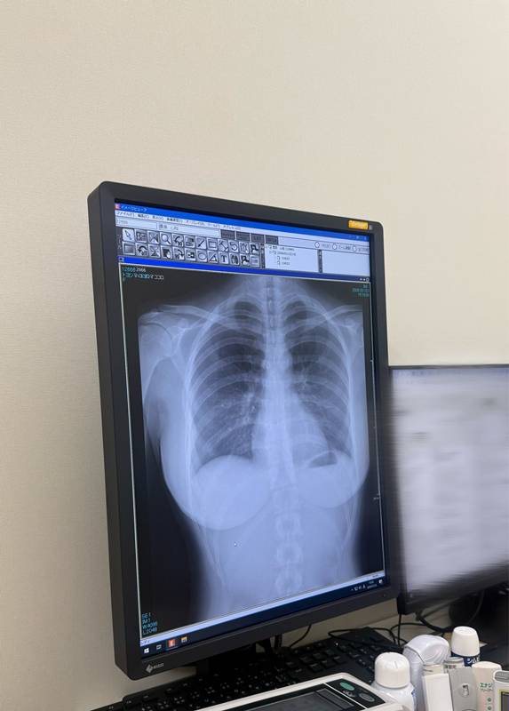 สาวกราเวียร์เผยภาพ X-Ray ปอด