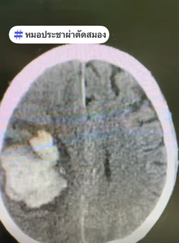 เส้นเลือดในสมองแตก เส้นเลือดในสมองแตก