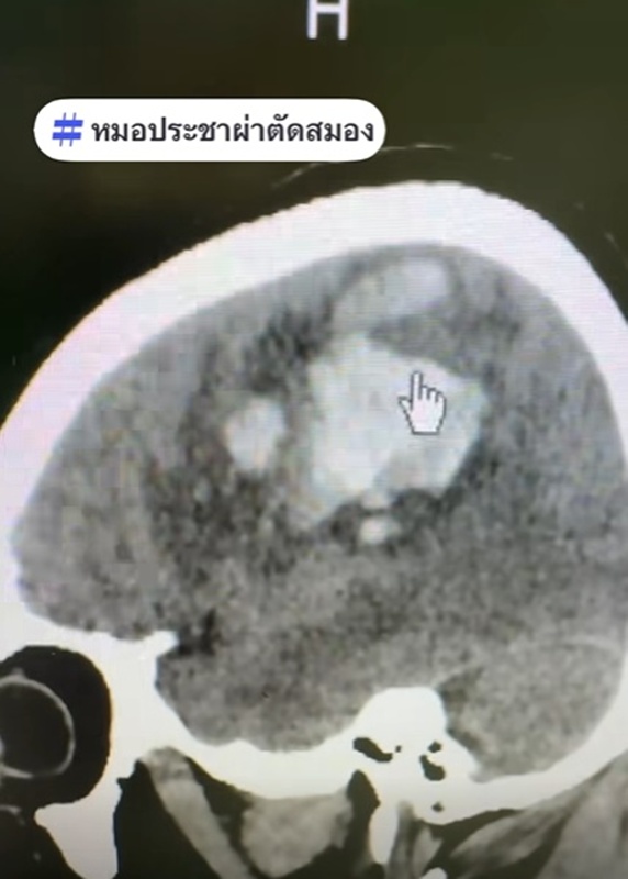 เส้นเลือดในสมองแตก