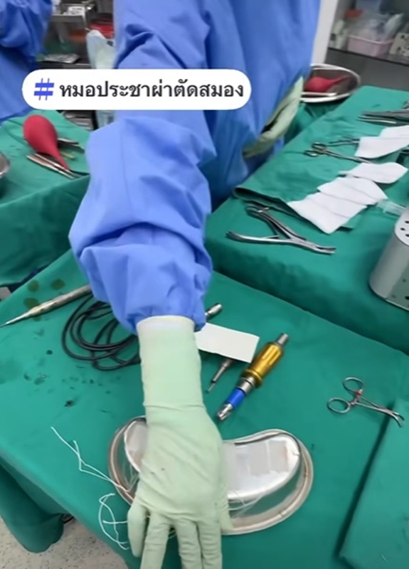 เส้นเลือดในสมองแตก