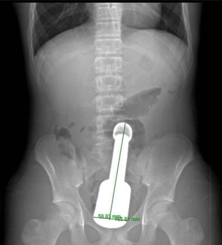 แท่งโลหะติดสำไส้เด็ก