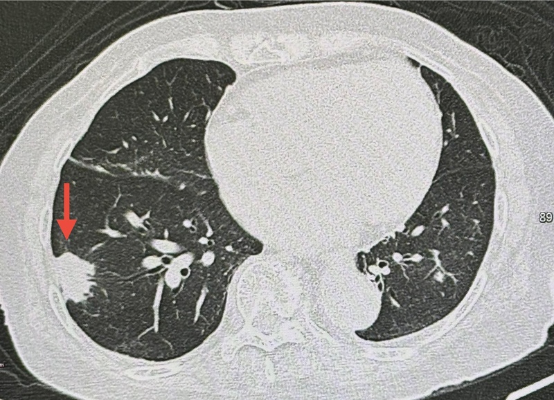 ปอดอักเสบ เพราะนกพิราบ