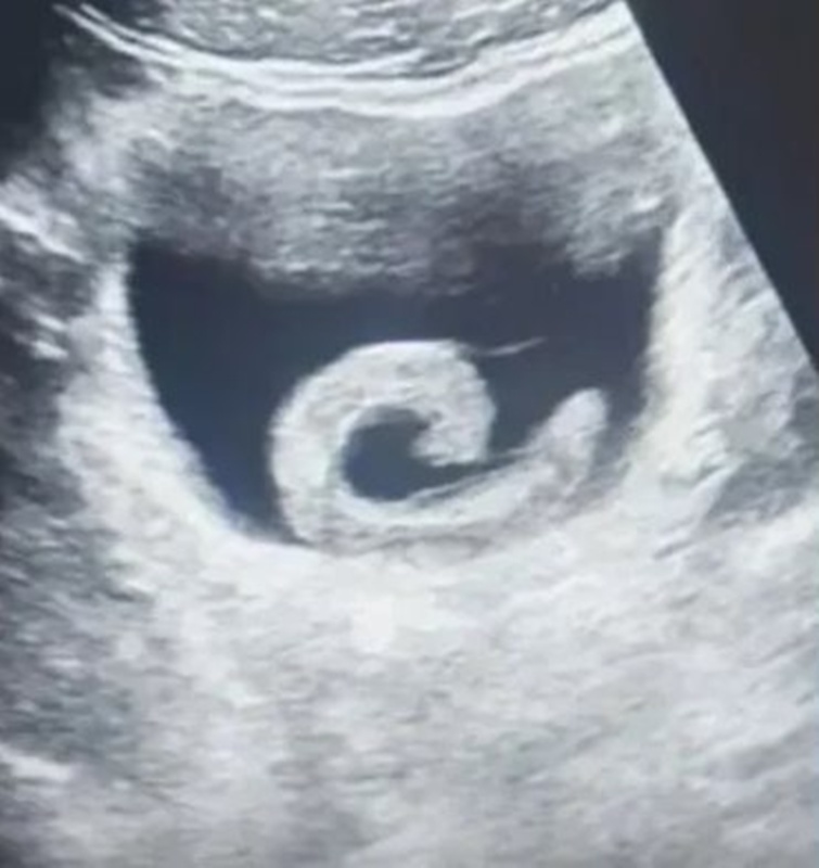 ปวดท้อง