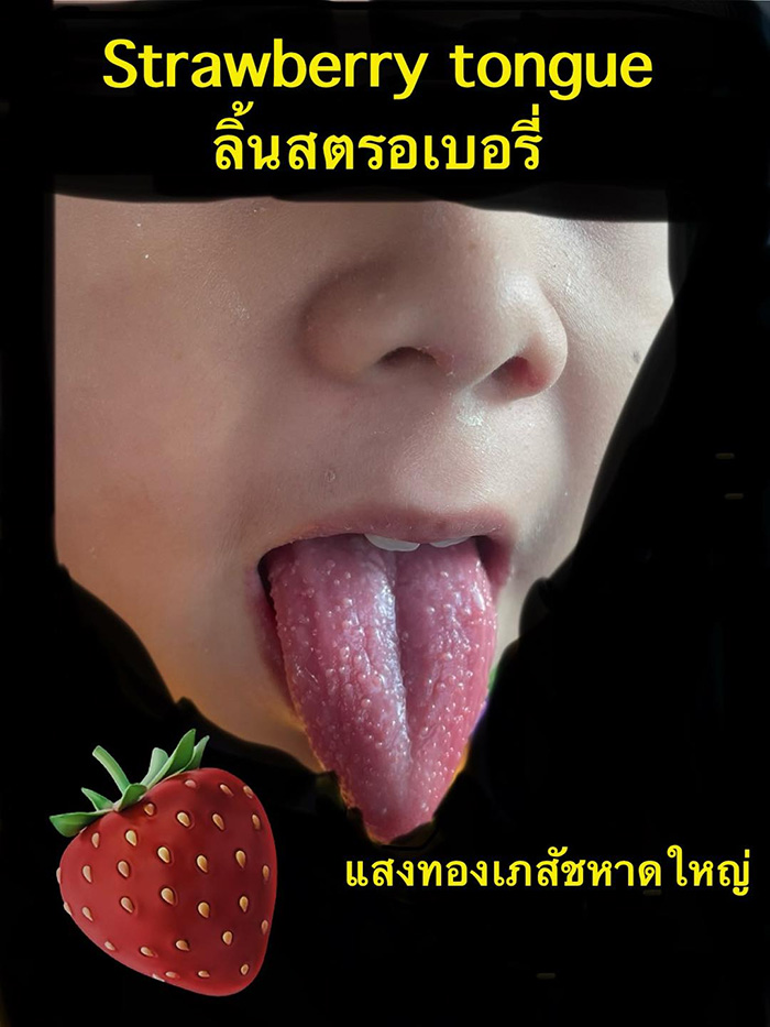 พ่อพาลูก 10 ขวบลิ้นสตรอว์เบอร์รีมาให้ดูว่าเป็นอะไร พ่อพาลูก 10 ขวบลิ้นสตรอว์เบอร์รีมาให้ดูว่าเป็นอะไร