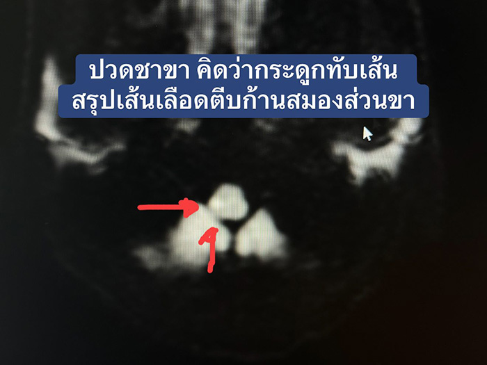 ขาชา 