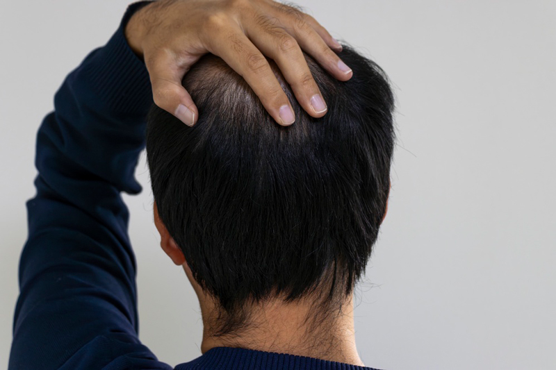 หัวล้าน